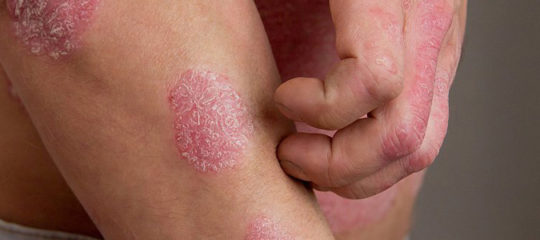 psoriasis