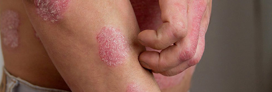 psoriasis